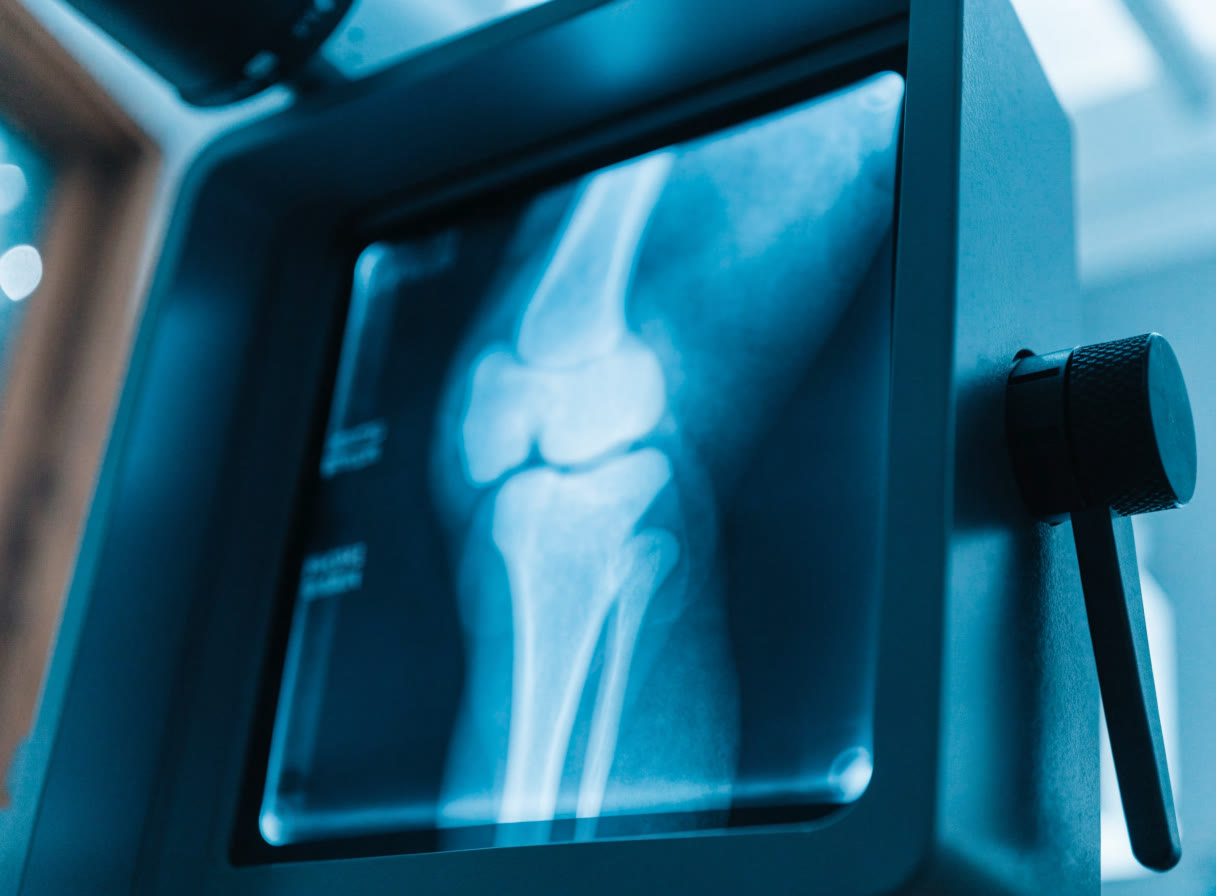 Negatoscopio iluminado con una radiografía de rodilla